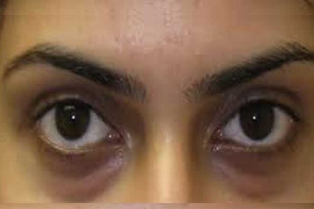 চোখের নিচে কালো দাগ দূর করার ঘরোয়া উপায়